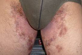 Tinea incognito