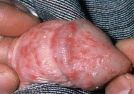 candida infection