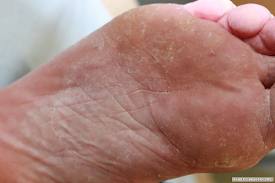 teniapedis dry